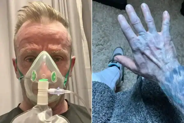 Homem acorda com a pele completamente azul e vai parar no hospital; causa surpreende médicos